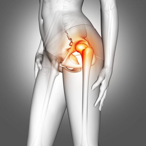 3D render of a female medical figure with hip bone highlighted